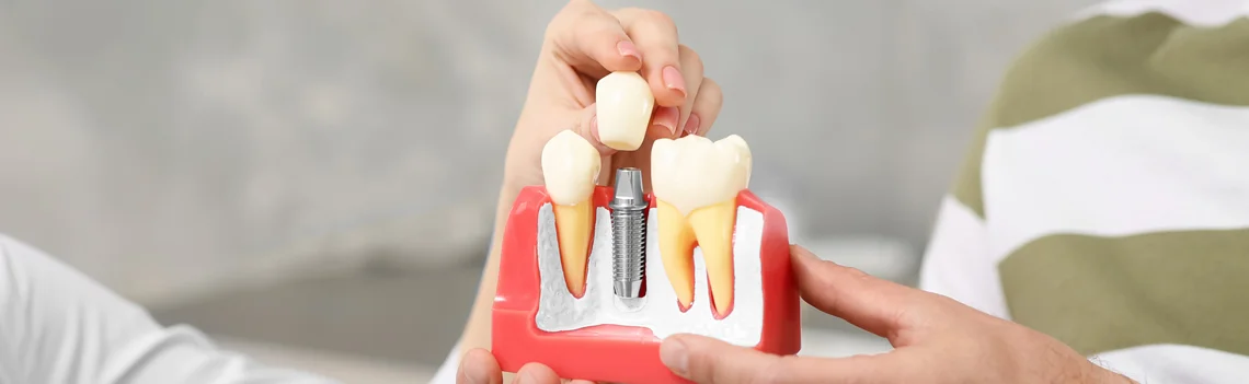 Dental Implants In Langley Township, BC