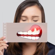 Gum Growth Around Dental Crowns: Causes, Effects, and Solutions
