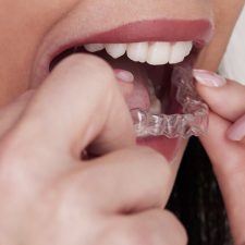 Best Practices for Maintaining Invisalign: Cleaning and Care Tips