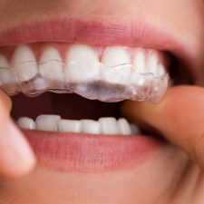 How Invisalign Can Correct Bite Issues: A Closer Look at Orthodontic Solutions