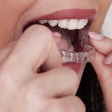 How Invisalign® Can Help Correct Overcrowded Teeth and Improve Your Smile