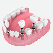 Full Mouth Extraction vs. Single Tooth Extractions: Which Is Right for You?