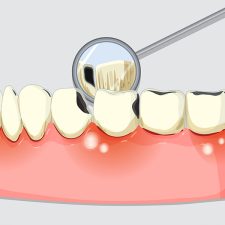 Top Periodontal Treatments to Protect Your Gums and Teeth