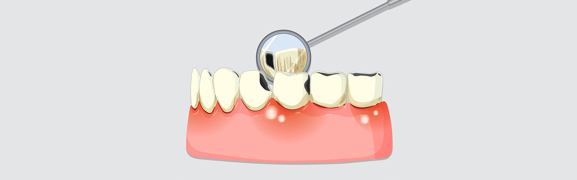 Top Periodontal Treatments to Protect Your Gums and Teeth